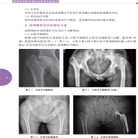 [M]股骨近端截骨重建全髋关节置换术-9787312028175