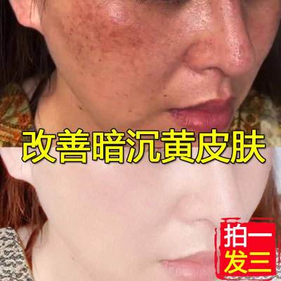 抖音同款-仁和药业爱肤宜美白精华水补水保湿祛黄嫩白面部精华液收缩毛孔淡痘印原液男女通用