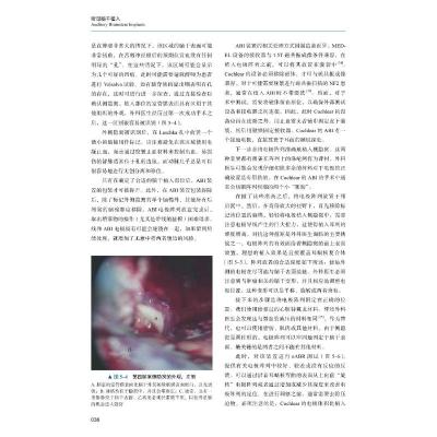 [正版]听觉脑干植入 (美)埃里克·P.威尔金森,(美)马克·S.施瓦兹 著 汪照炎 译 外科学医师参考资料图书 医学类