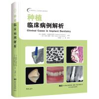 种植临床病例解析