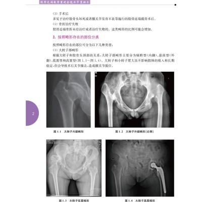 股骨近端截骨重建全髋关节置换术