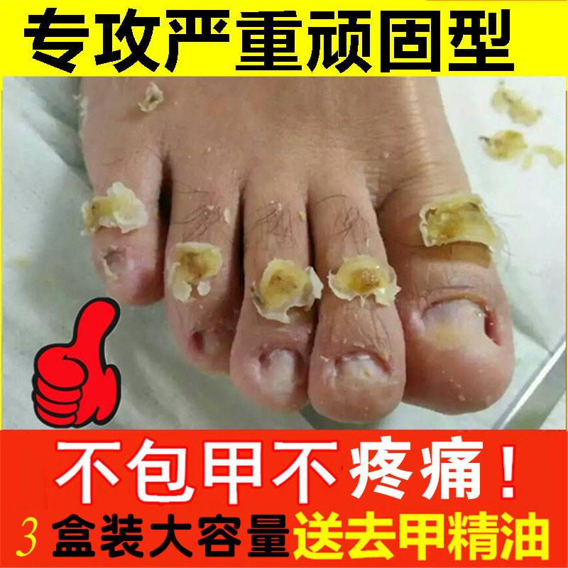 灰指甲专用液灰甲水脱甲液软甲膏去除增厚指甲修复液药水灰甲净